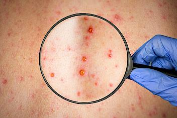 Image of shingles symptoms being examined