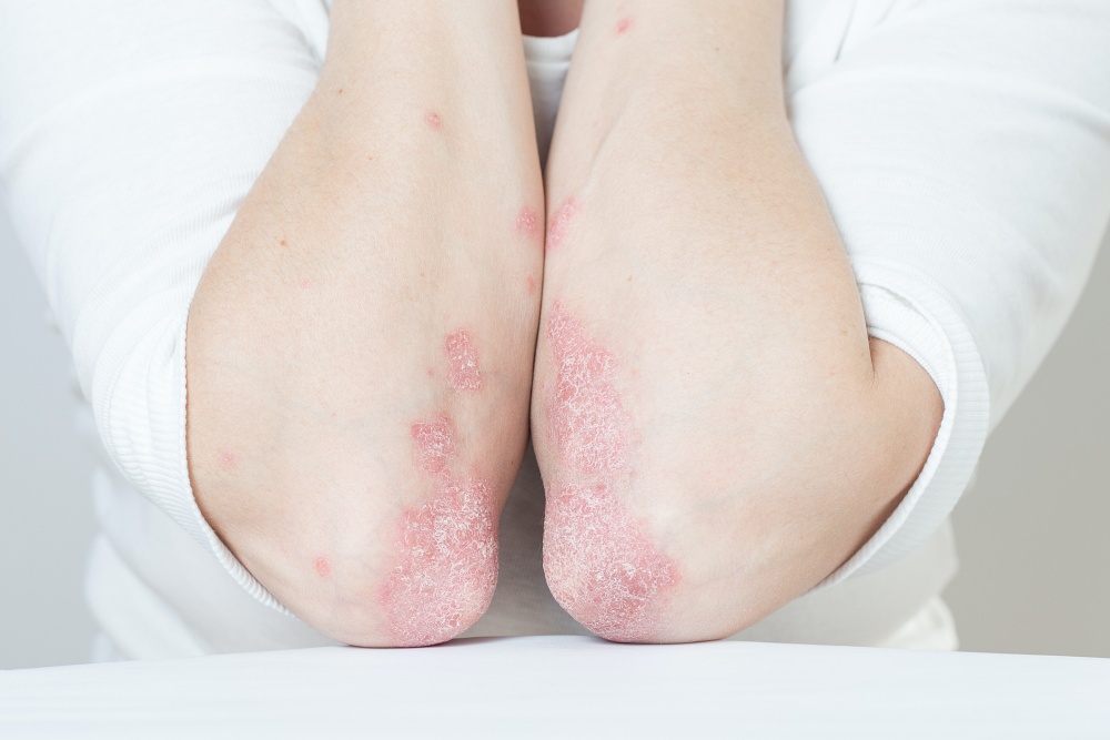 Image of eczema on person's elbows and arms
