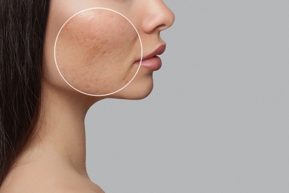 Image of woman with acne